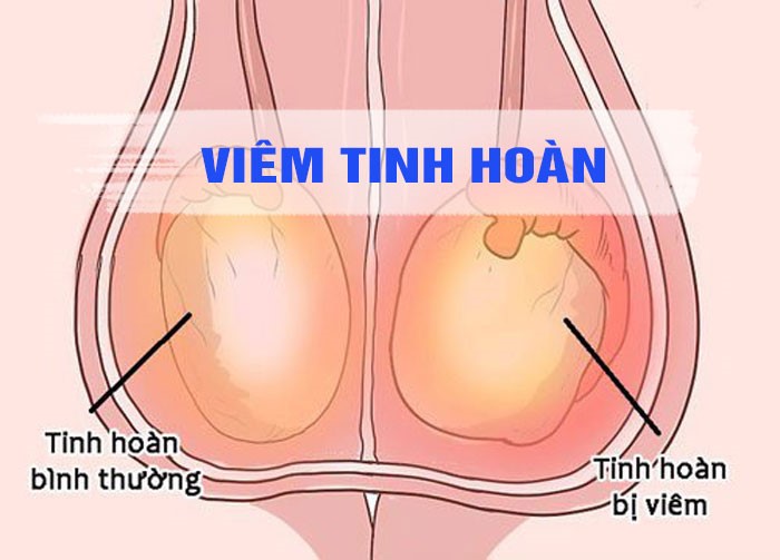 Viêm tinh hoàn có nguy hiểm không? – Bệnh viện Hữu nghị Việt Tiệp